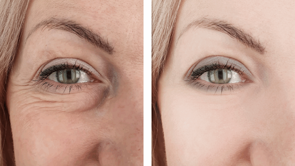 consulta sobre blefaroplastia com oftalmologista em Itu