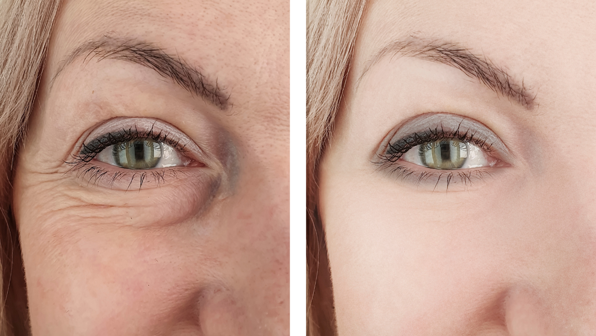 consulta sobre blefaroplastia com oftalmologista em Itu
